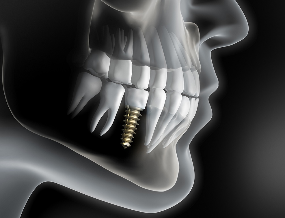 Animated smile with a dental implant supported replacement tooth
