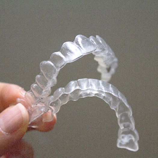 An up-close look at the customized Invisalign aligners used to treat a patient’s smile