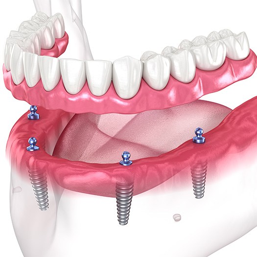 Illustration of dentures being attached to dental implants for All-on-4