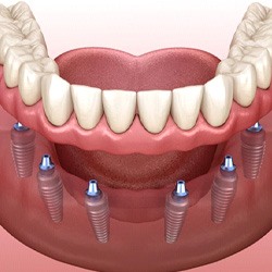 Implant denture for lower dental arch