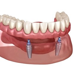 Ball-retained implant denture for lower arch