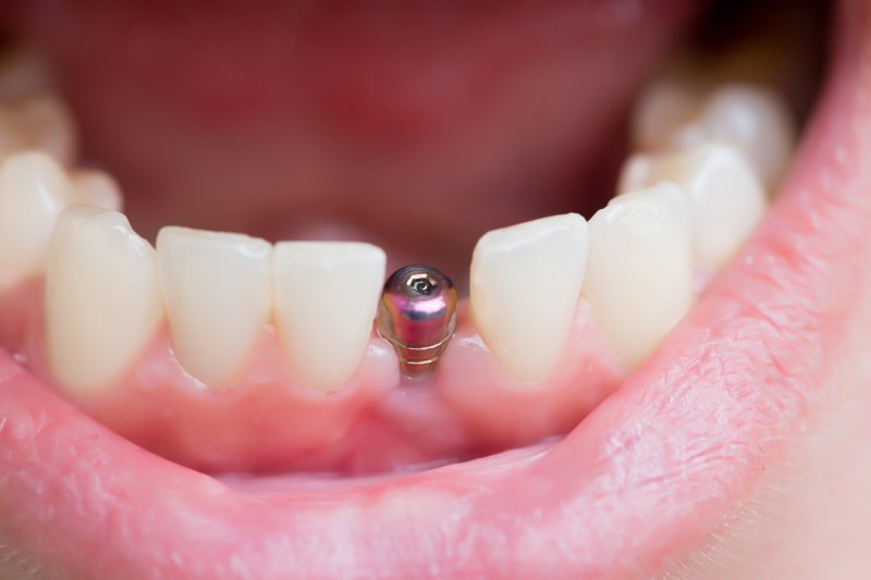 Dental implant in gum